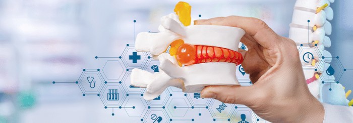 5 Common Misconceptions About Stem Cell Therapy for Herniated Discs