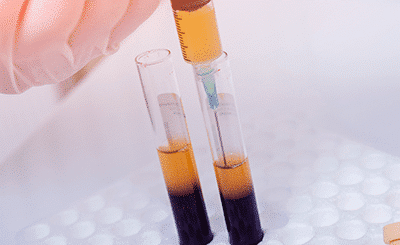 Everything You Need to Know About Stem Cell Therapy vs PRP