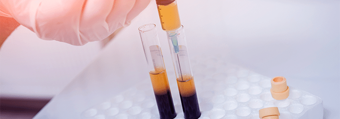 Everything You Need to Know About Stem Cell Therapy vs PRP