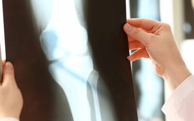 Can Osteoarthritis Be Improved by Stem Cell Therapy?