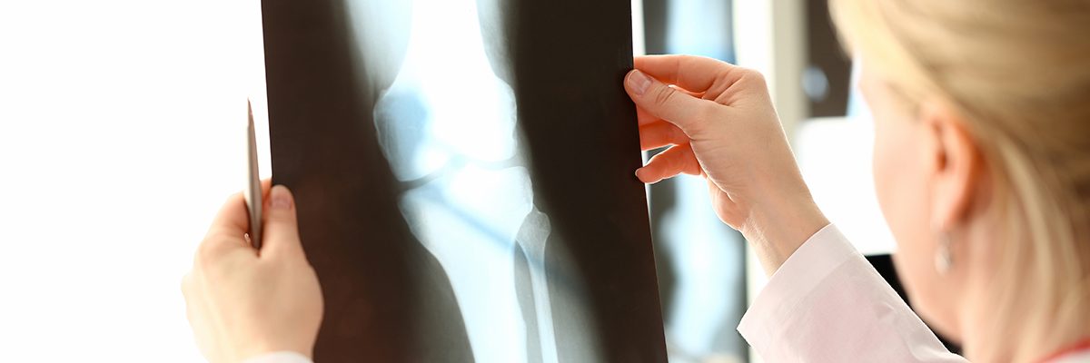 Doctor or clinician holding an X-ray of a knee joint up to the light, examining it in a clinical setting.